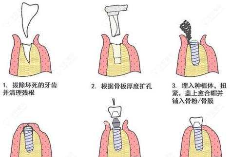 即刻种植有哪些适应条件？