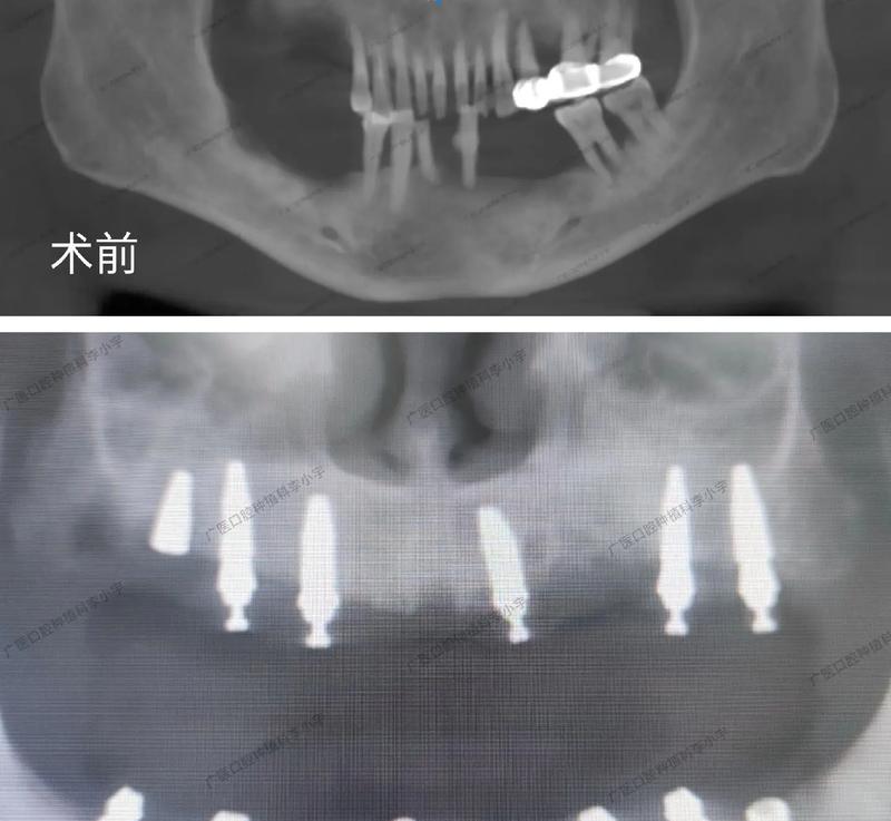 即刻种植有哪些适应条件？